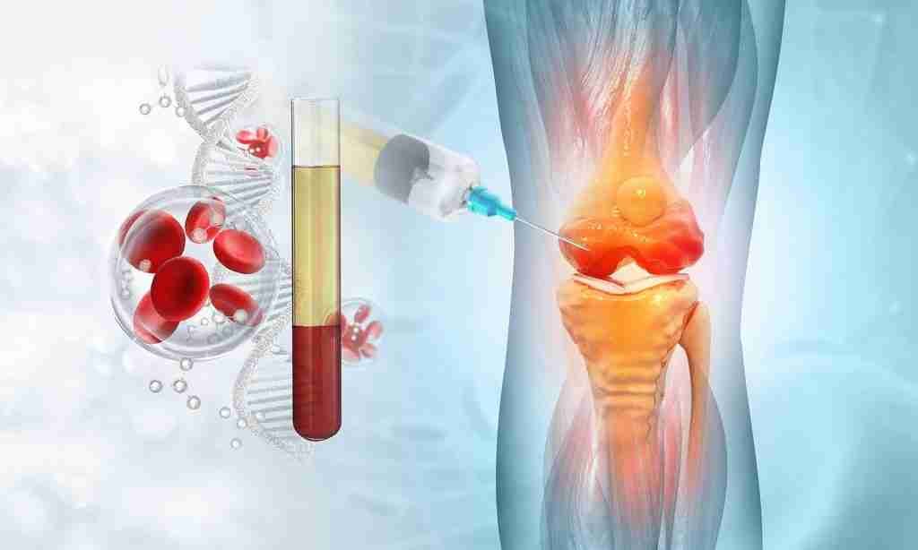 Plasma Ricco di Piastrine (PRP)
